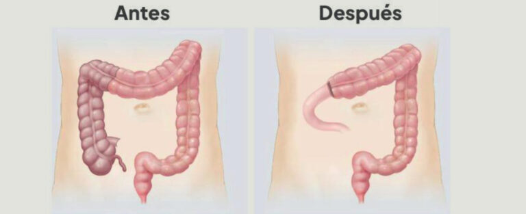 Cirugia Colorrectal Cirugia Colorrectal