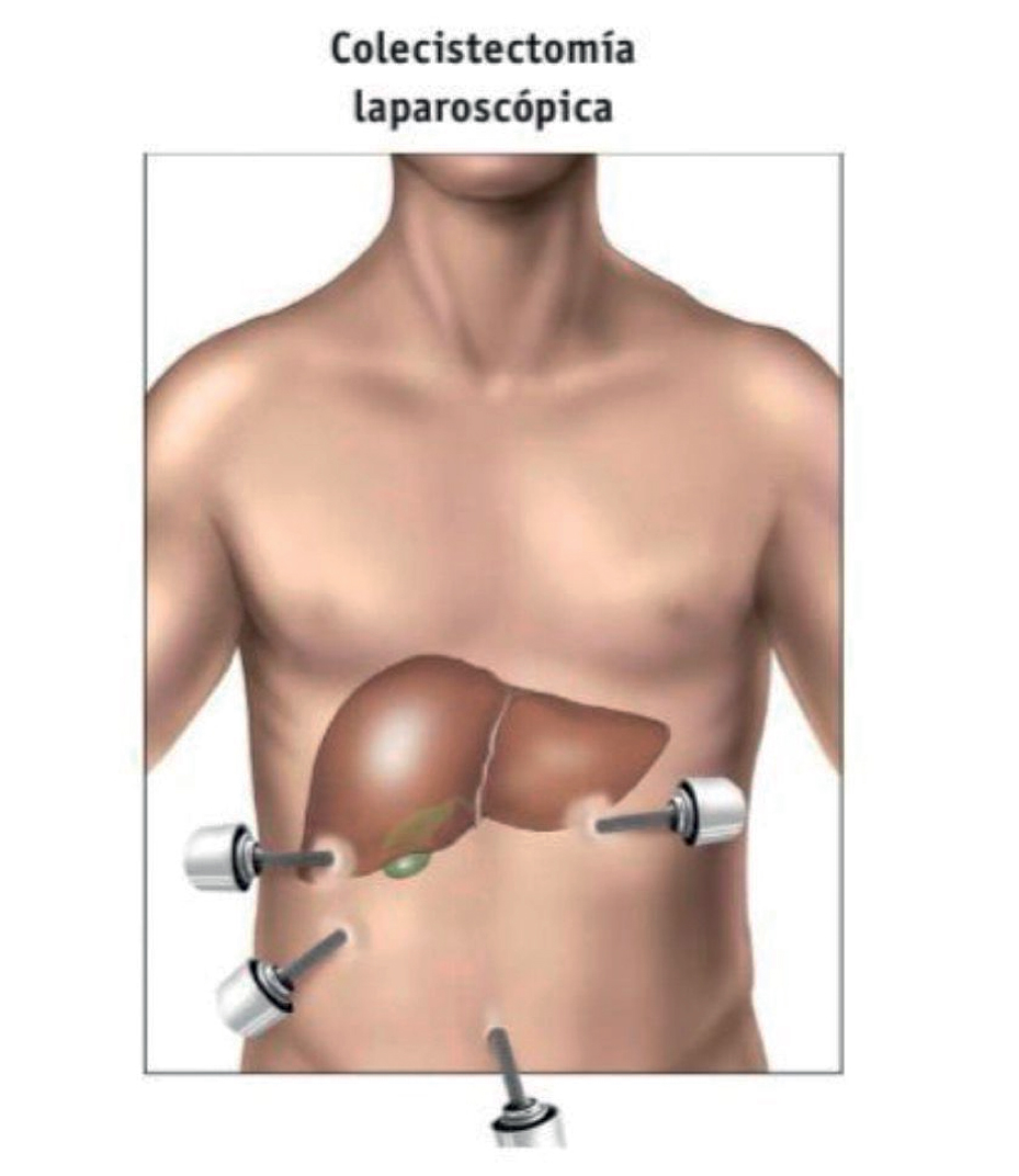 Colecistectomía Laparoscópica Colecistectomía Laparoscópica