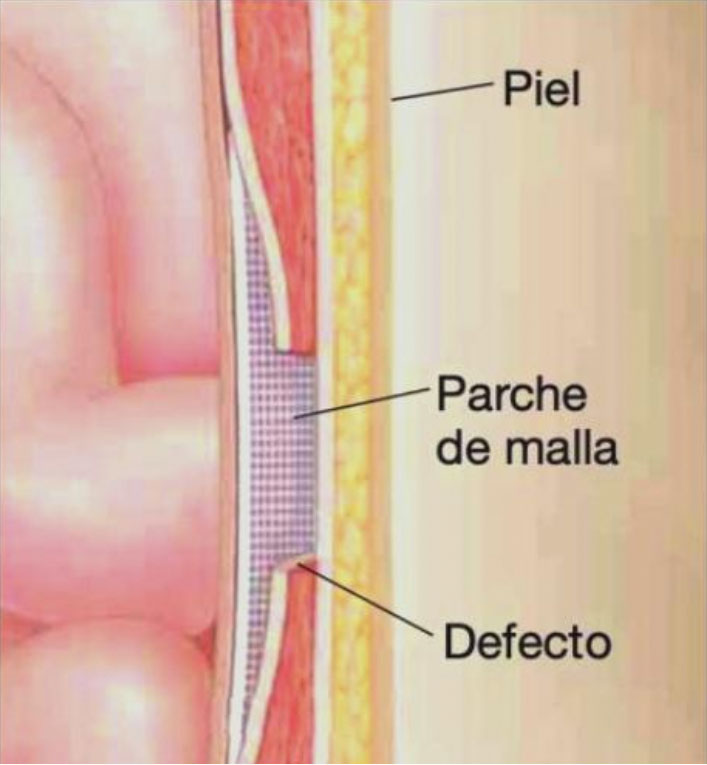 malla