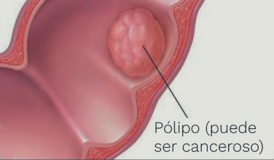 Pólipo Colorrectal Pólipo Colorrectal